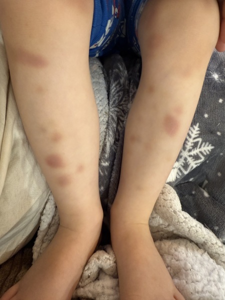 Are these bruises normal in a four-year-old or worth checking?