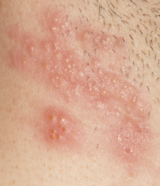 Does anyone think shingles?