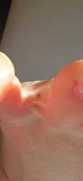 Noticed a black spot between toes.