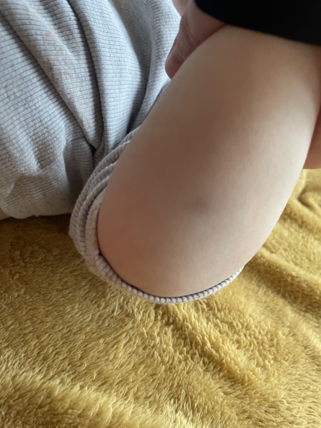 22 month is old bruising - Concerning?