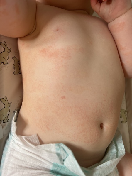 Rash after MMRV vaccine in 12 month old with sickness
