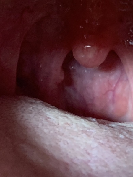 Any dentists about or GPs? Small hard lump roof of mouth