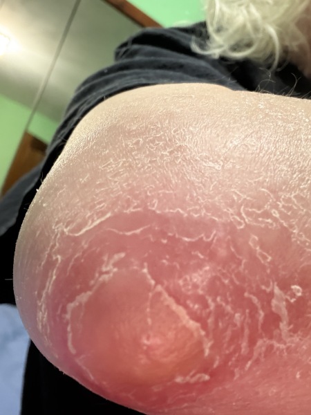 Infected Elbow Joiny Capsule