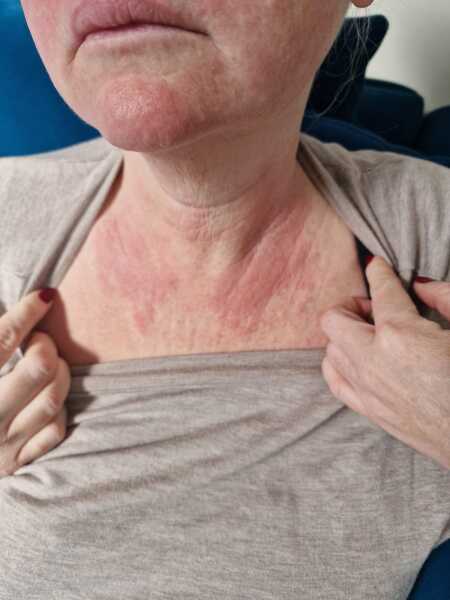 Woke up with an itchy burning rash on my chest