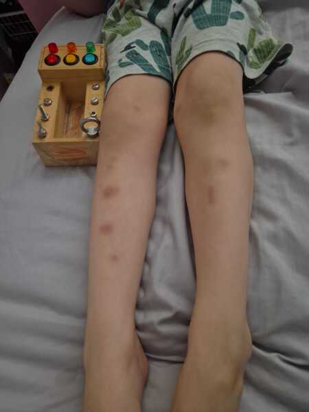 My youngest keeps bruising.