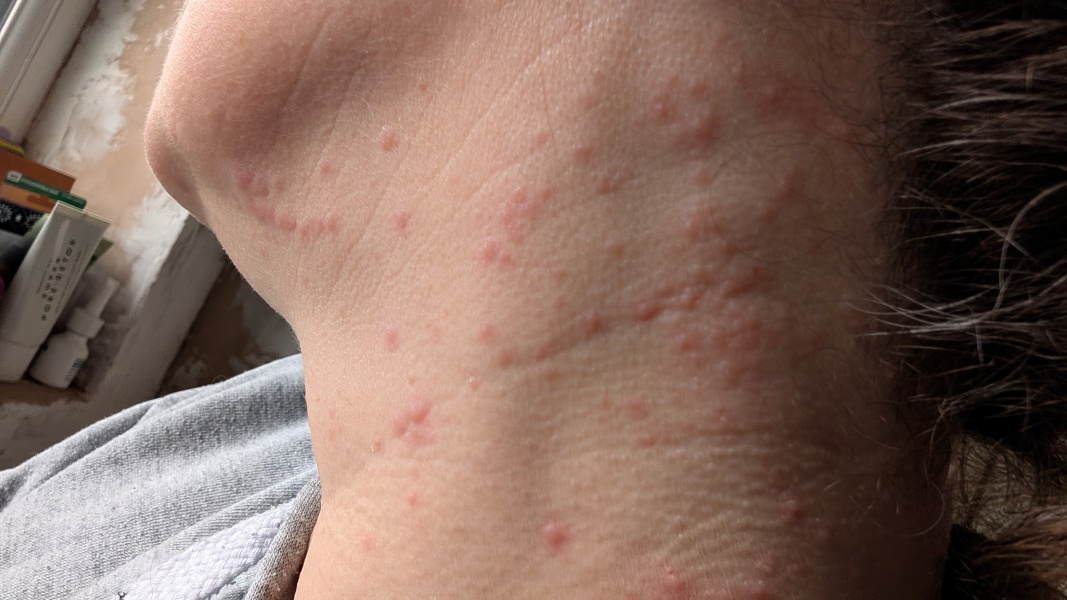 Does anyone think shingles?