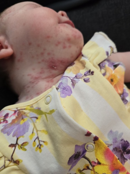 8 month old with severe chickenpox spots, has anyone had similar?