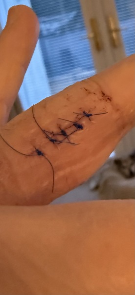 Are these stitches ok and not infected? Pic included