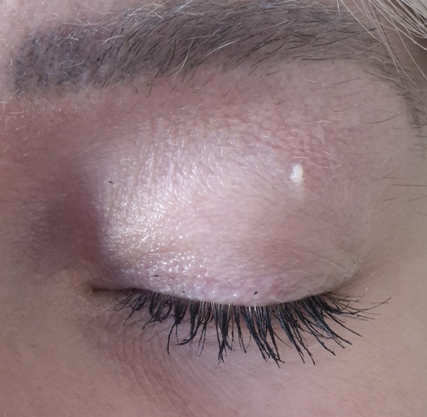 Any idea what this eye bump is?