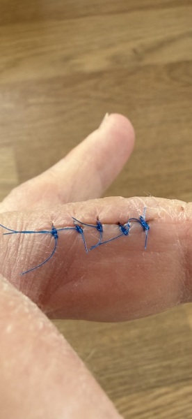 Are these stitches ready to come out?