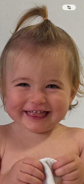 Dimple caused by cheek injury