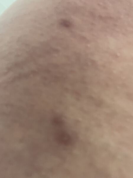 Folliculitis or something else?