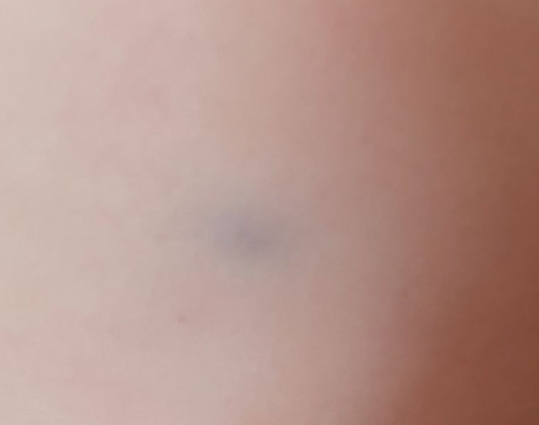 22 month is old bruising - Concerning?
