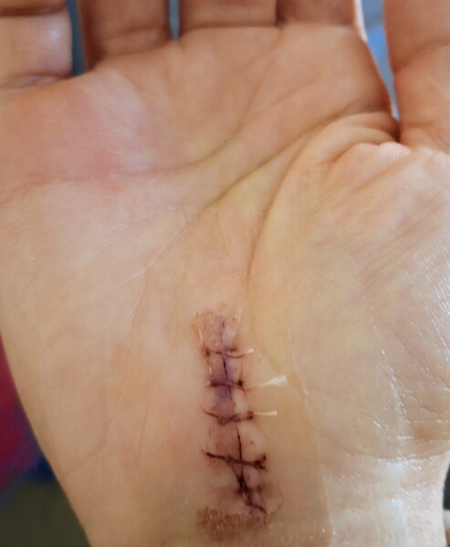 Are these stitches ok and not infected? Pic included