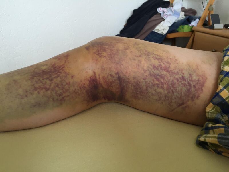 Bruising after surgery