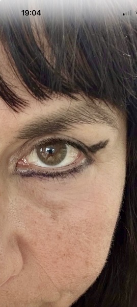 Facelift, temporal brow lift advice please !