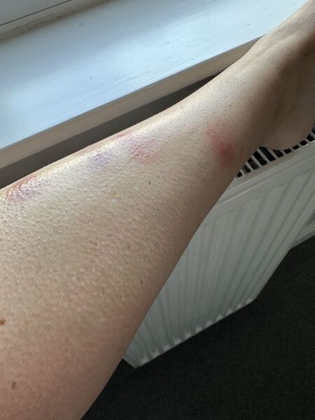 Any doctor or pharmacist - mosquito bites