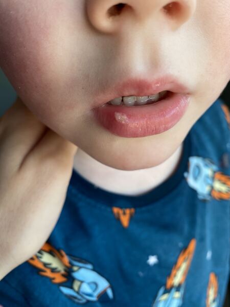 Ulcer or cold sore?