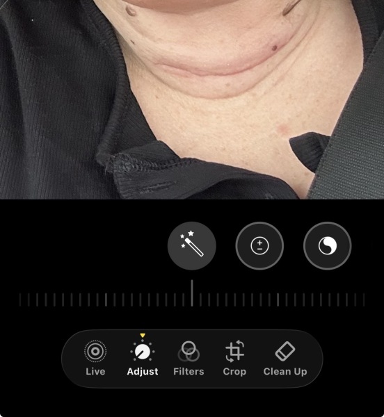 Hemithyroidectomy for Thy3F nodule