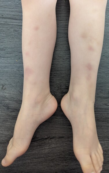 My youngest keeps bruising.