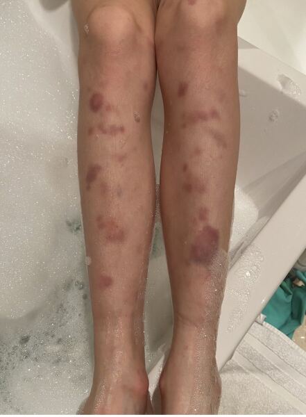 My youngest keeps bruising.