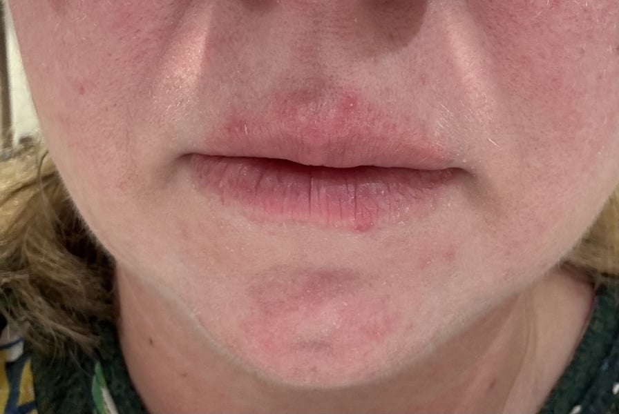 Little spots and redness around lip line, any suggestions?