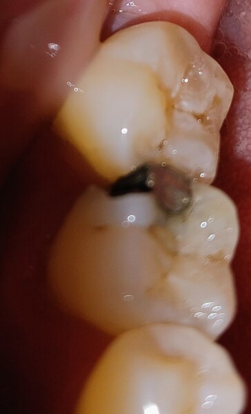 Failed filling - do I have to pay to get it repaired?