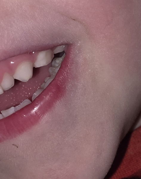 Does this look like the start of a cold sore on my son's lip?