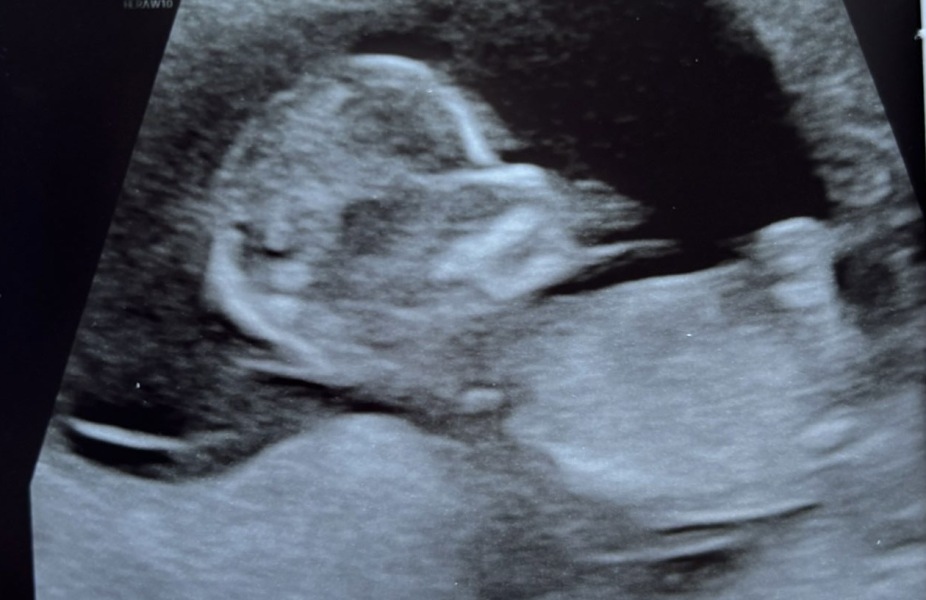 Boy or girl? Nub/skull theory (just for fun!)