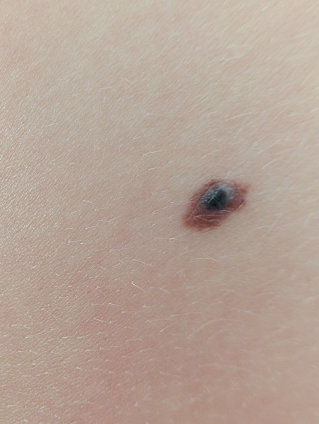 To tell you all to check your moles! (and wear good SPF) 