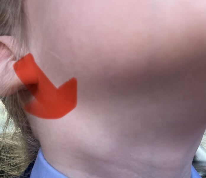 DD5 referred to paediatrician on the urgent cancer pathway for lymph node- petrified