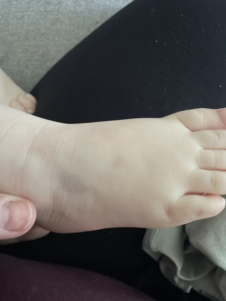 22 month is old bruising - Concerning?