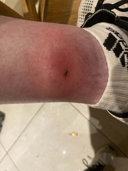 Angry insect bite