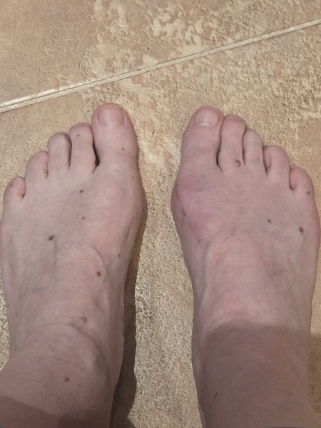 How the hell to cope with bunions?!
