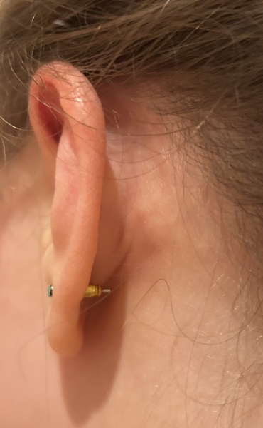 Lymph node behind behind ear for a month