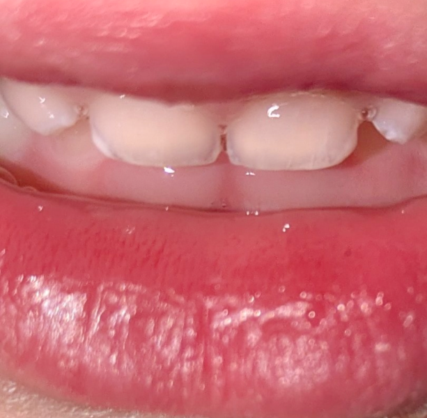 Toddler tooth decay?