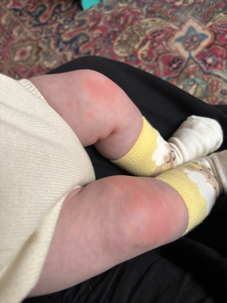 GP ignoring allergy concerns