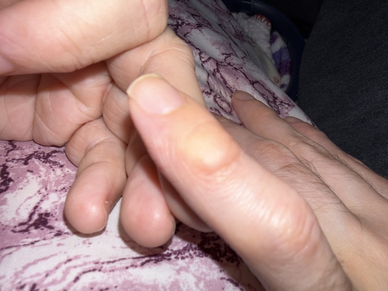 Lump on finger