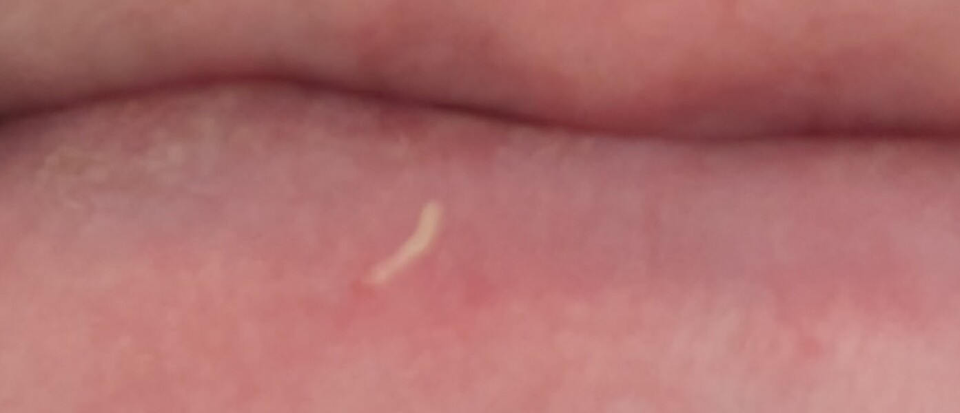 Please enjoy this impressive whitehead from below my lip
