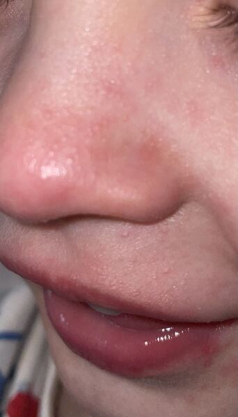 Strange rash after being outside