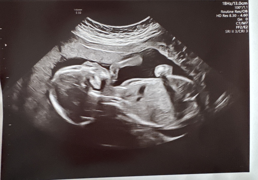 Any gender clues from my 20 week scan image?