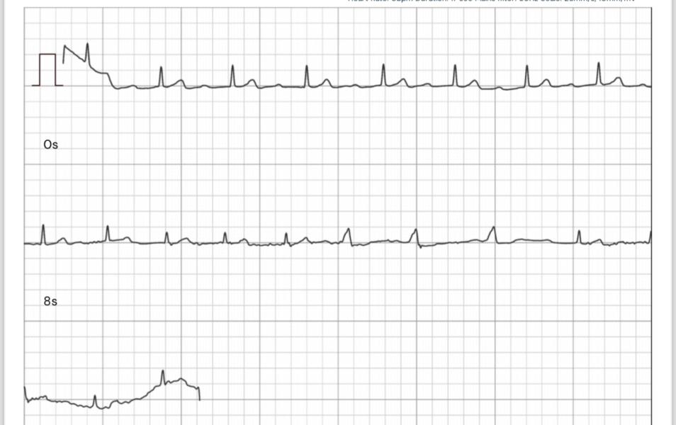 Is anyone able to take a quick look at a heart tracing?❤️