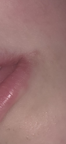 Do these spots look like pimples or possible cold sores?