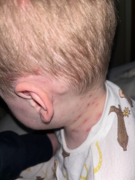 Chicken Pox - Lymph Node?