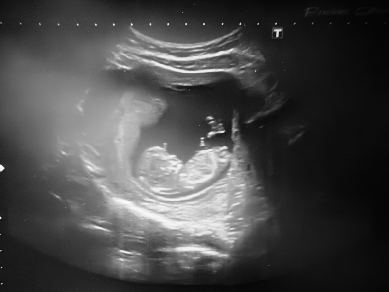 Any guesses on baby's sex from my pregnancy scan?