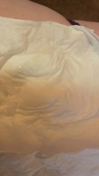 TMI is this implantation discharge