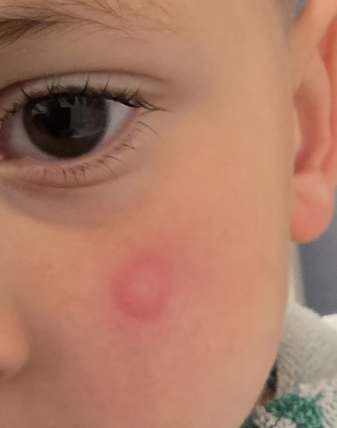 Discoid eczma?