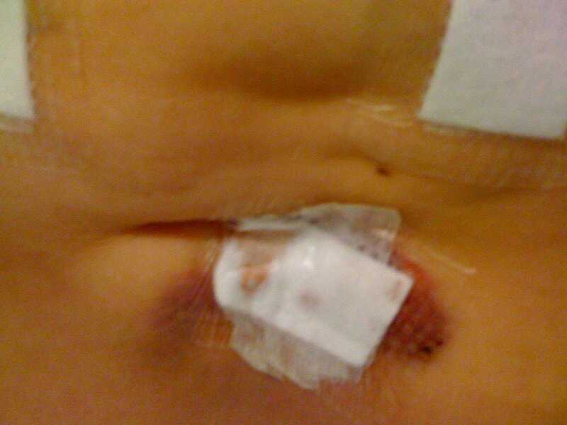 Bruising after surgery