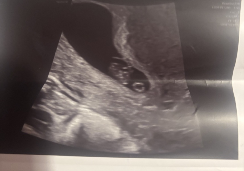 Any fun Ramzi theory guesses for baby from abdominal scan?