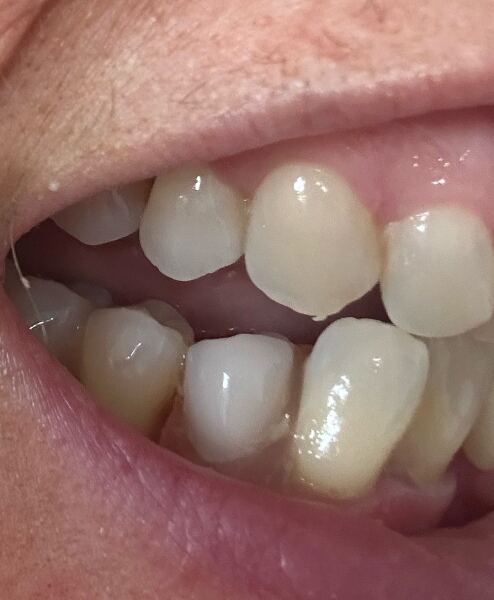 Partial denture advice